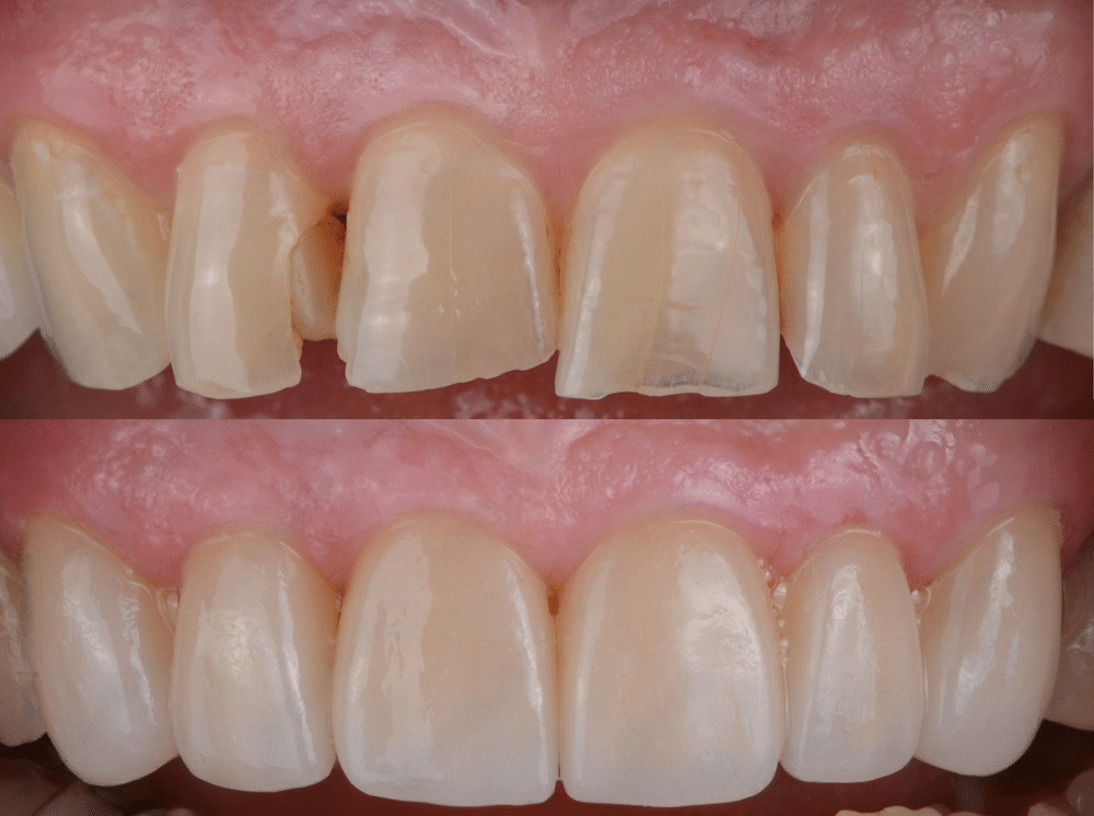 Cracks Teeth Before & After