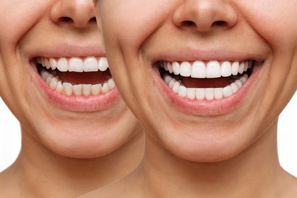 Dental veneers Before & After