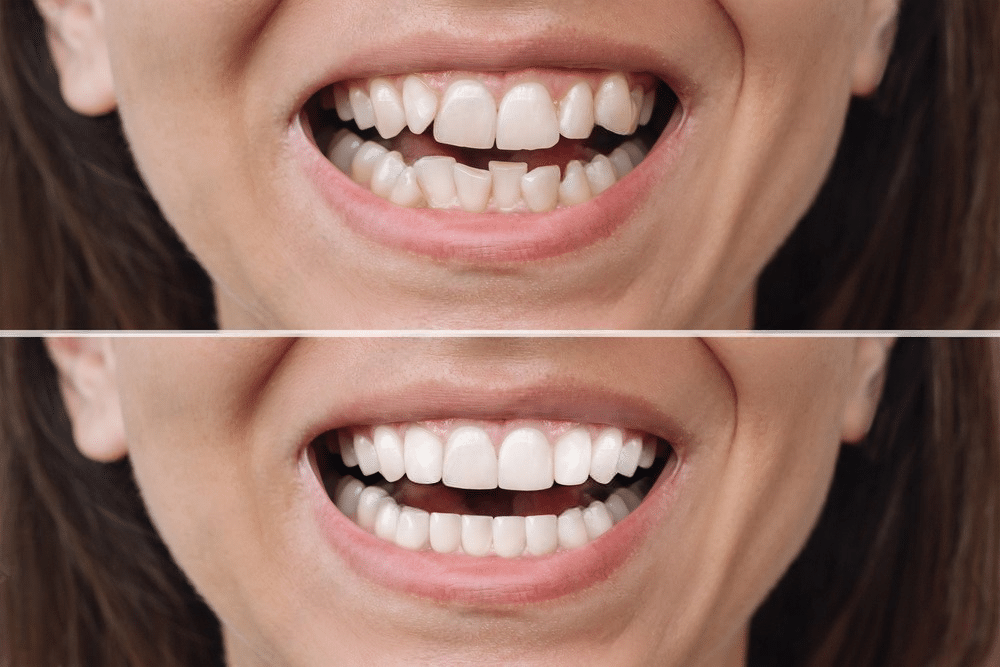 Misaligned Teeth Before & After